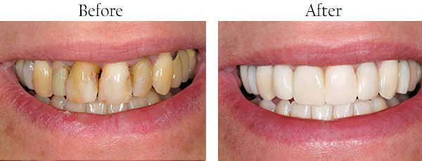 Smile design with Veneers and Laminates 2